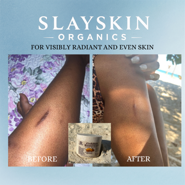 Heal your skin with slay skin Golden Renewal Body Butter